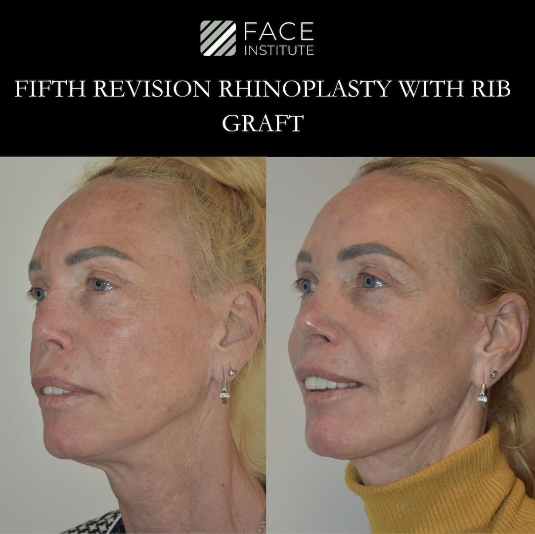 Revision Rhinoplasty 3