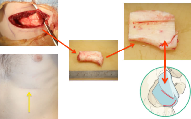 Replace septum and upper lateral cartilages