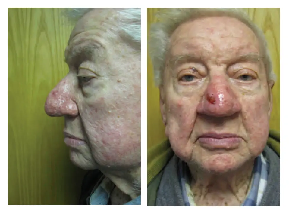 Rhinophyma Correction After