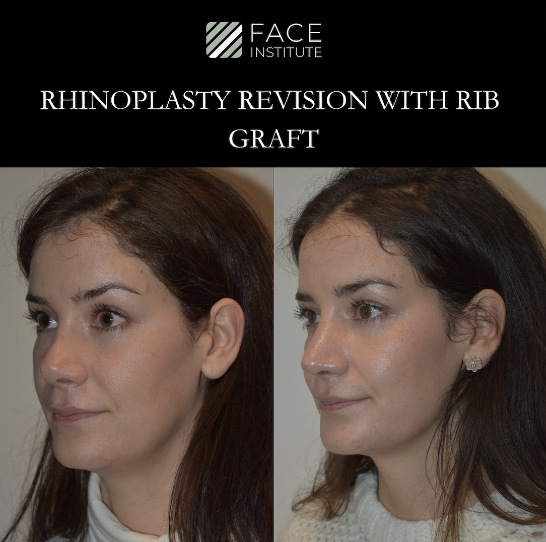 Revision Rhinoplasty 5 A