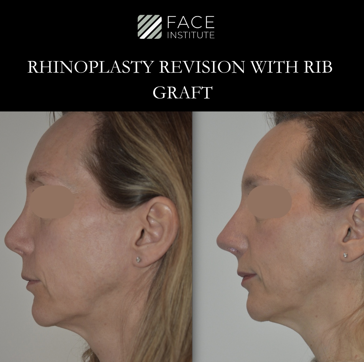 Revision Rhinoplasty 6 A