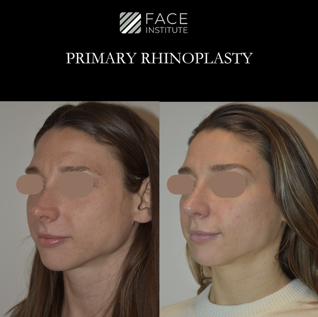 Primary Rhinoplasty 1B