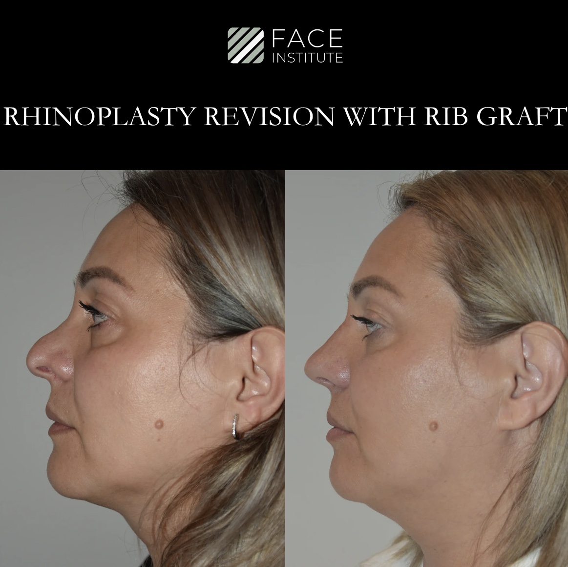 Revision Rhinoplasty 1 A