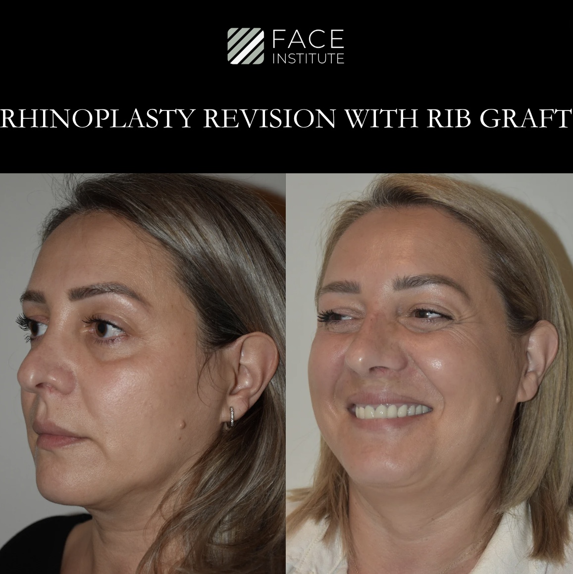 Revision Rhinoplasty 1 B