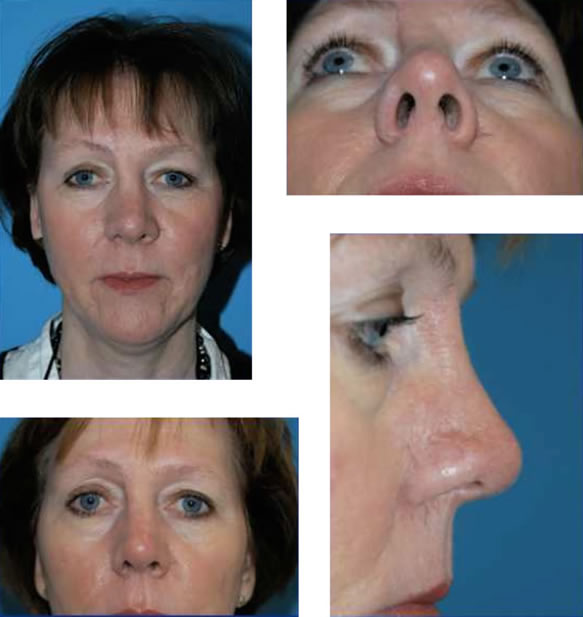 Forehead flap reconstruction
