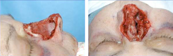Partial Nasal Amputation - Large nasal defect