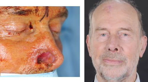 Reconstruction of loss of half of the nose