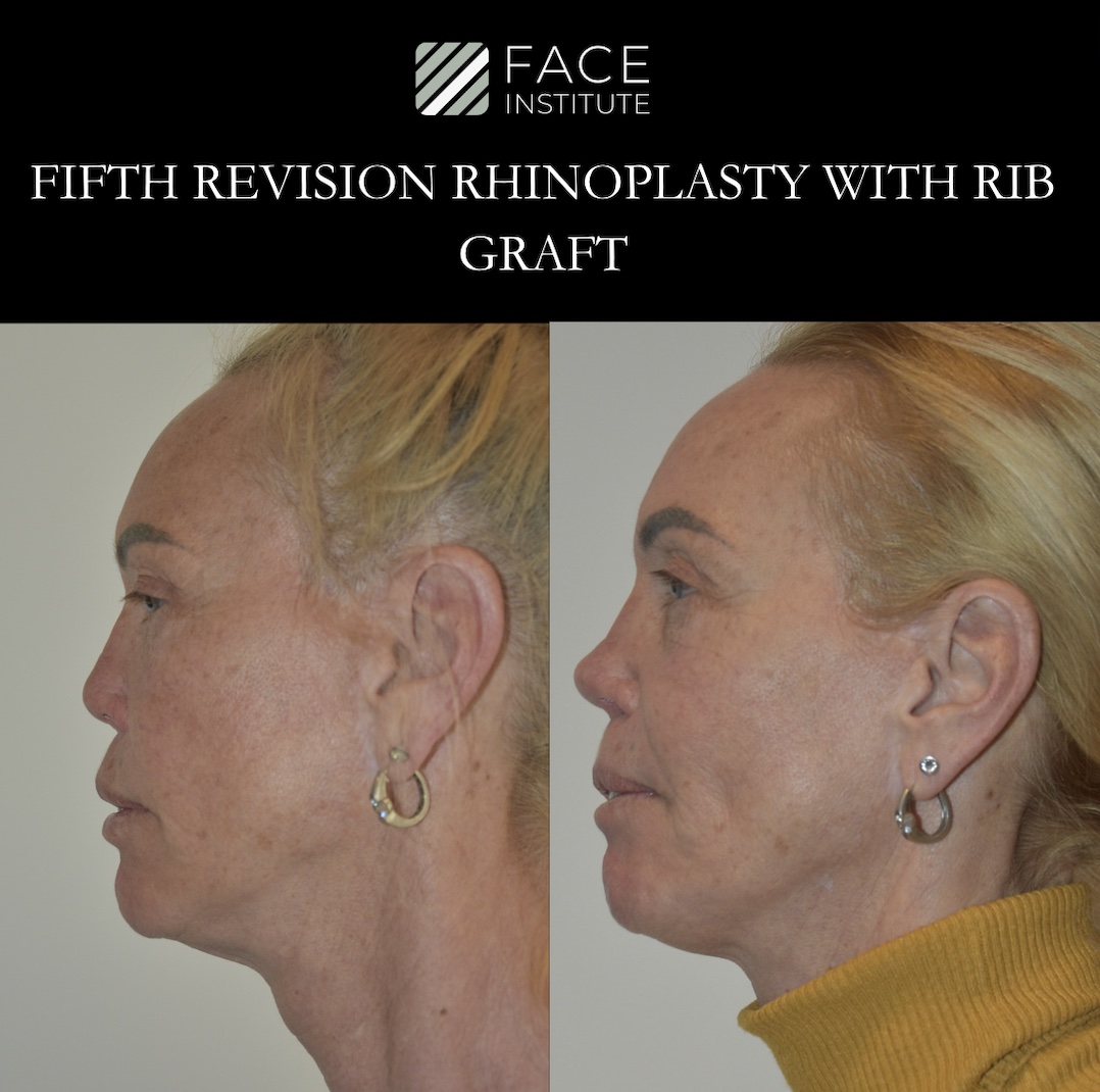 Revision Rhinoplasty 2
