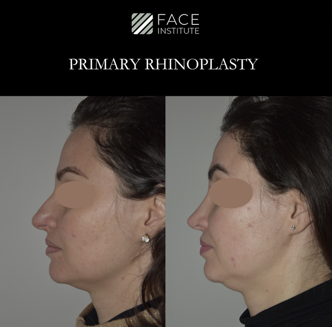 Primary Rhinoplasty 2A