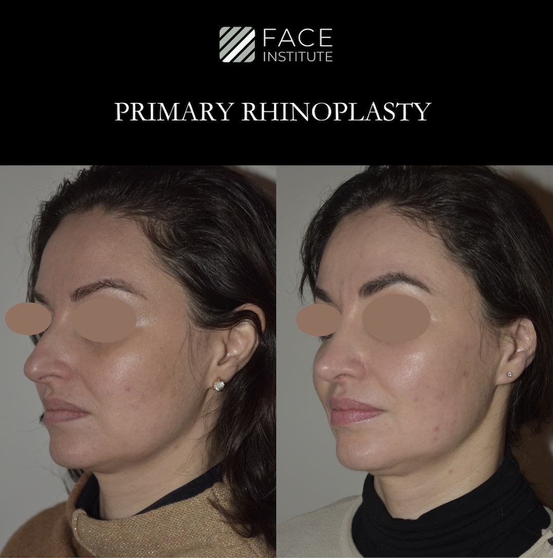 Primary Rhinoplasty 2B
