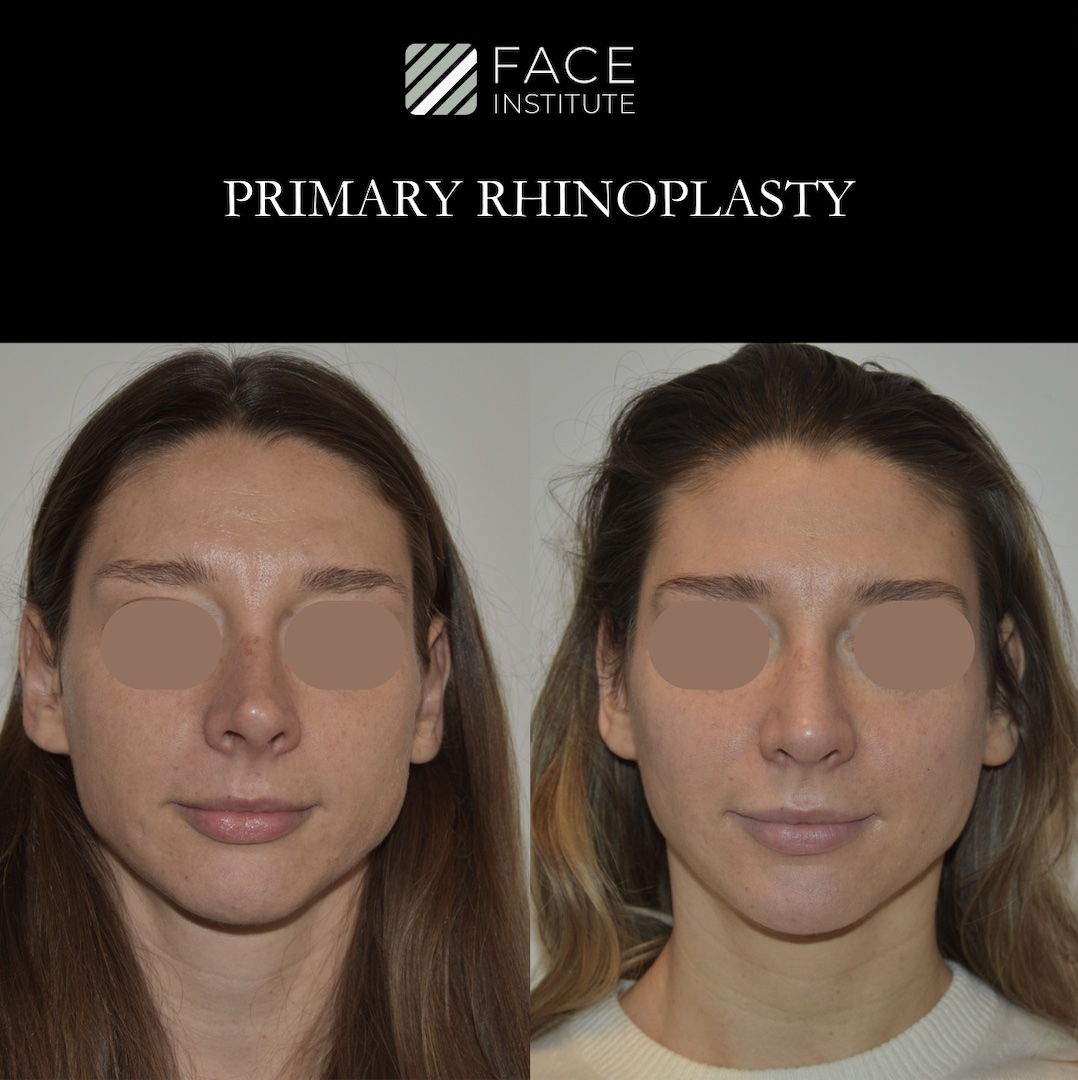 Primary Rhinoplasty 1C