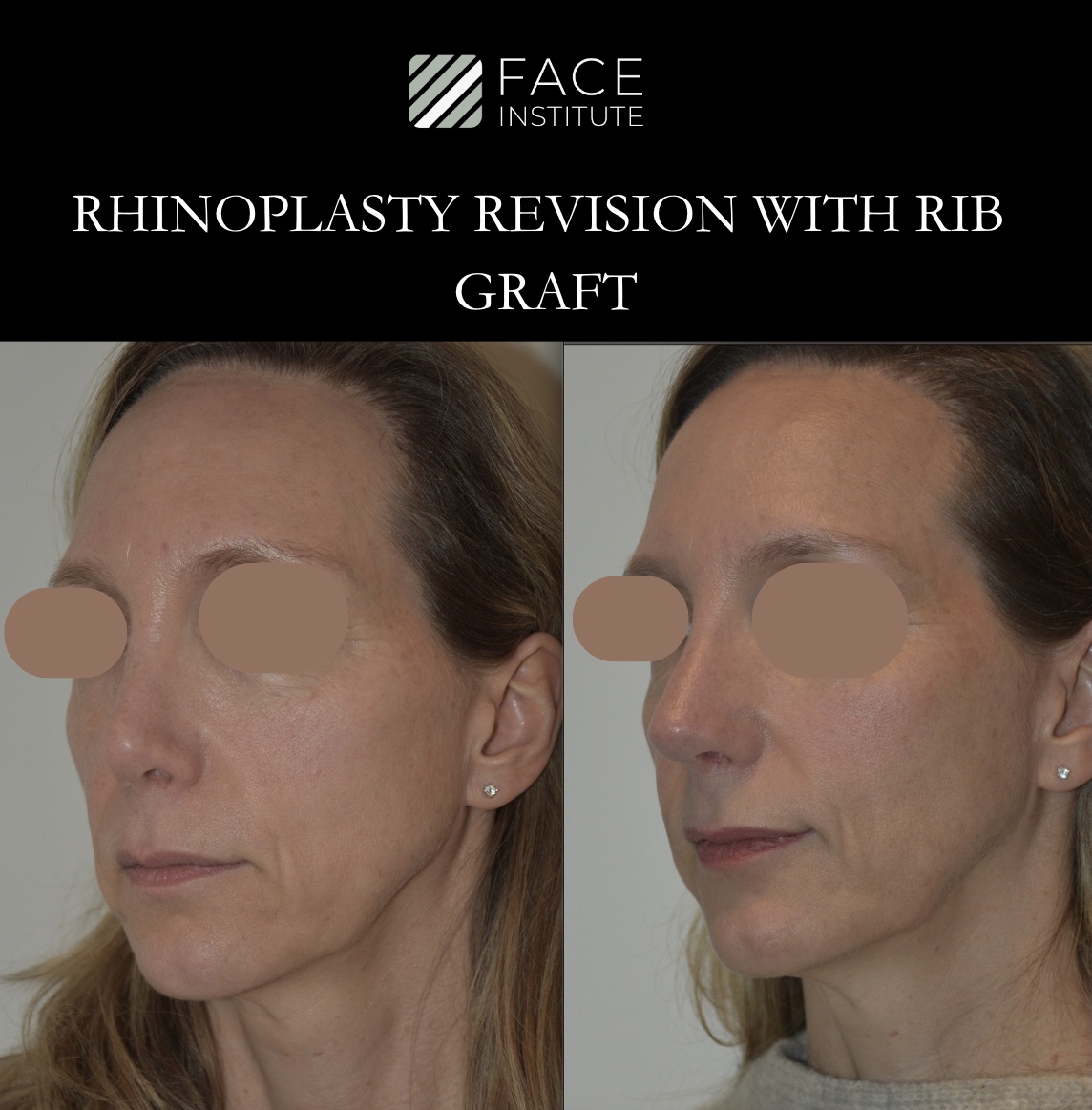 Revision Rhinoplasty 6B