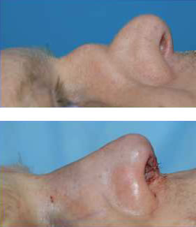 Saddle Nose Deformity