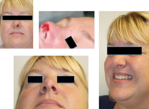 Small defects can be repaired with a free composite graft with high success rates in one operation.