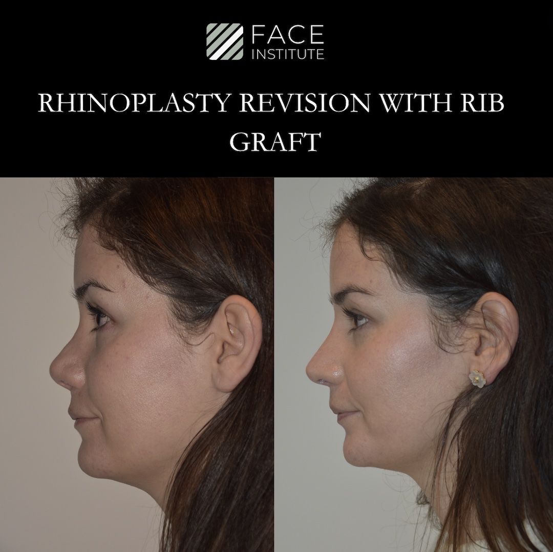 Revision Rhinoplasty 4