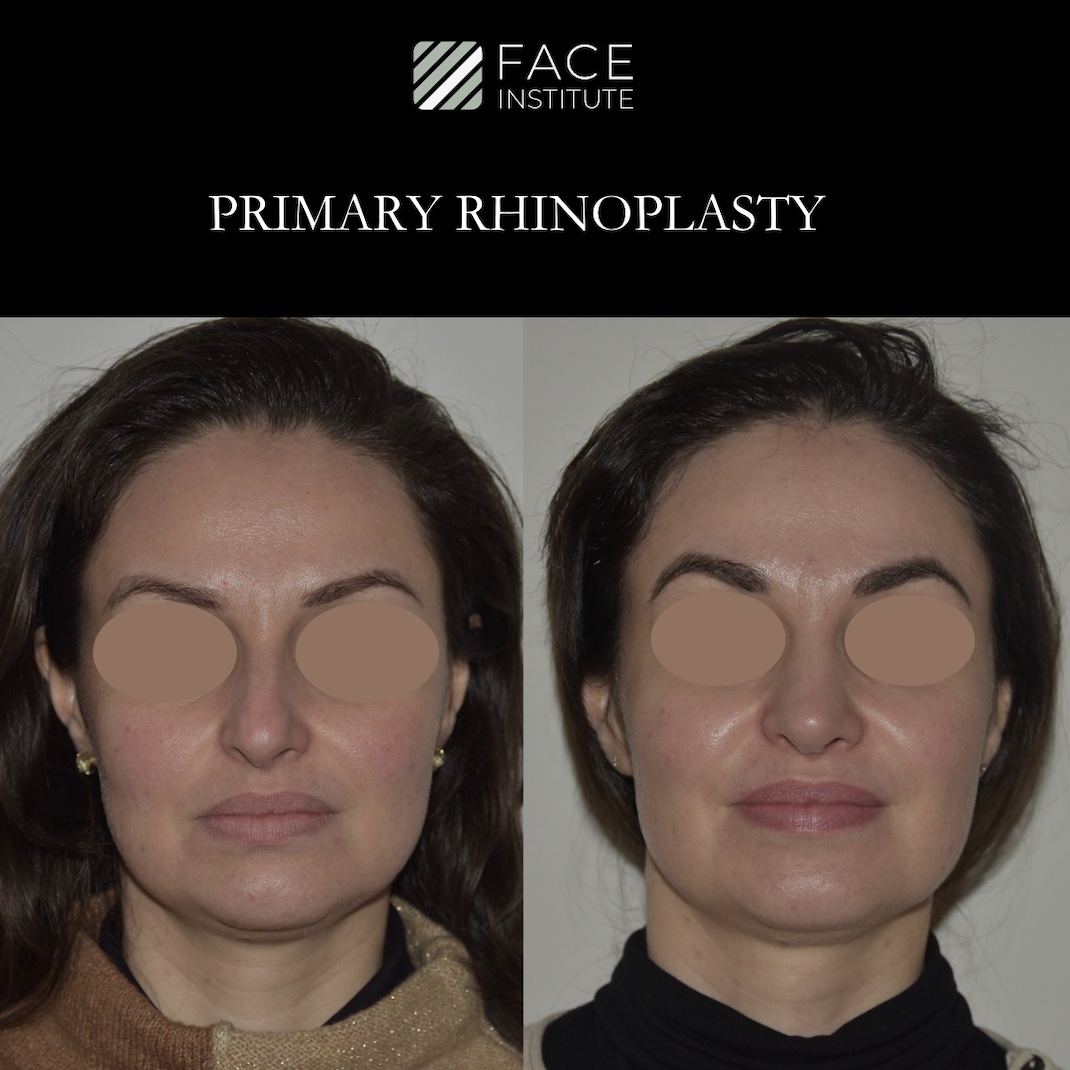 Primary Rhinoplasty 2C