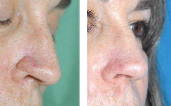 Stigmata of a reconstructed nose hidden