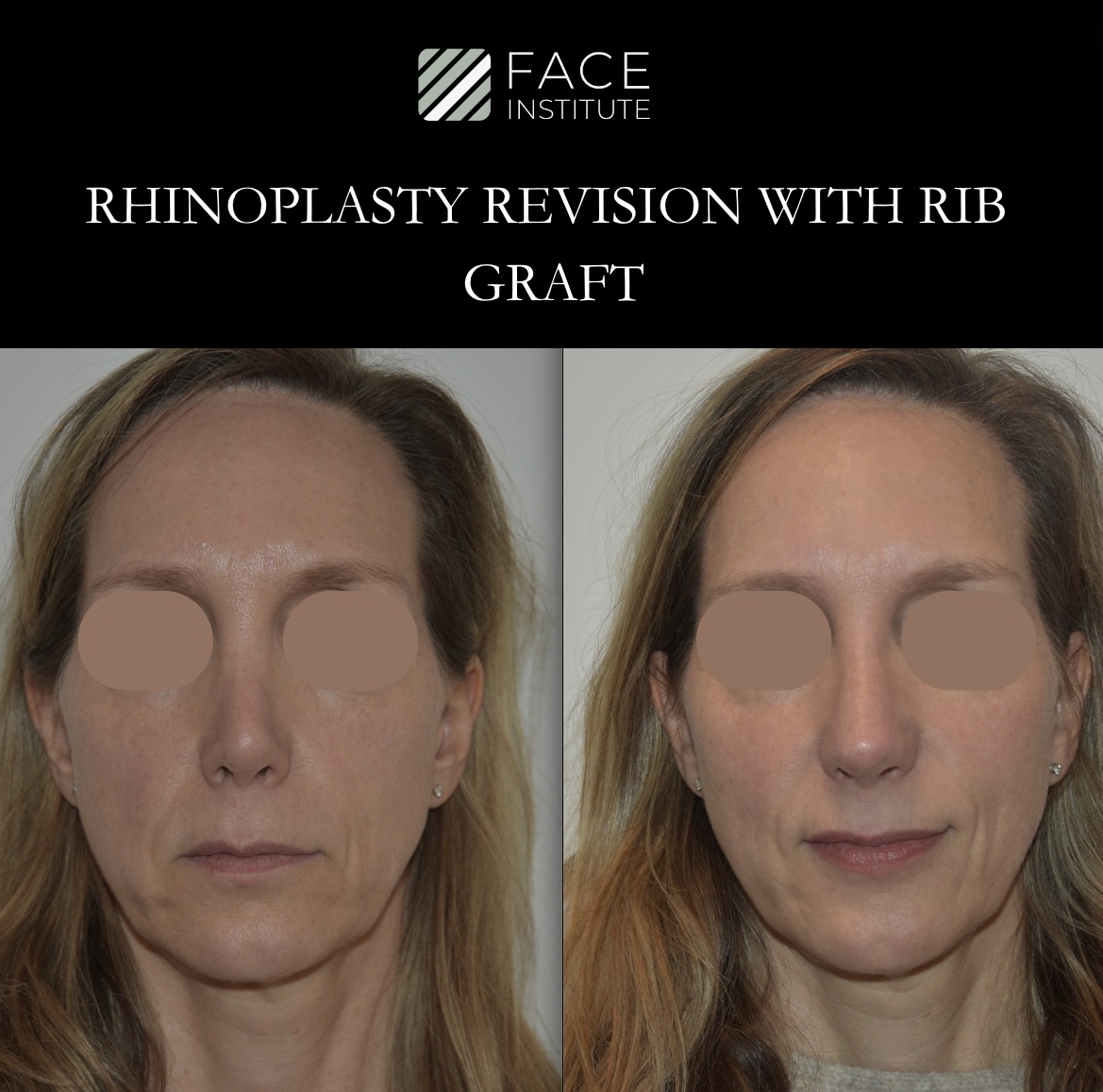 Revision Rhinoplasty C
